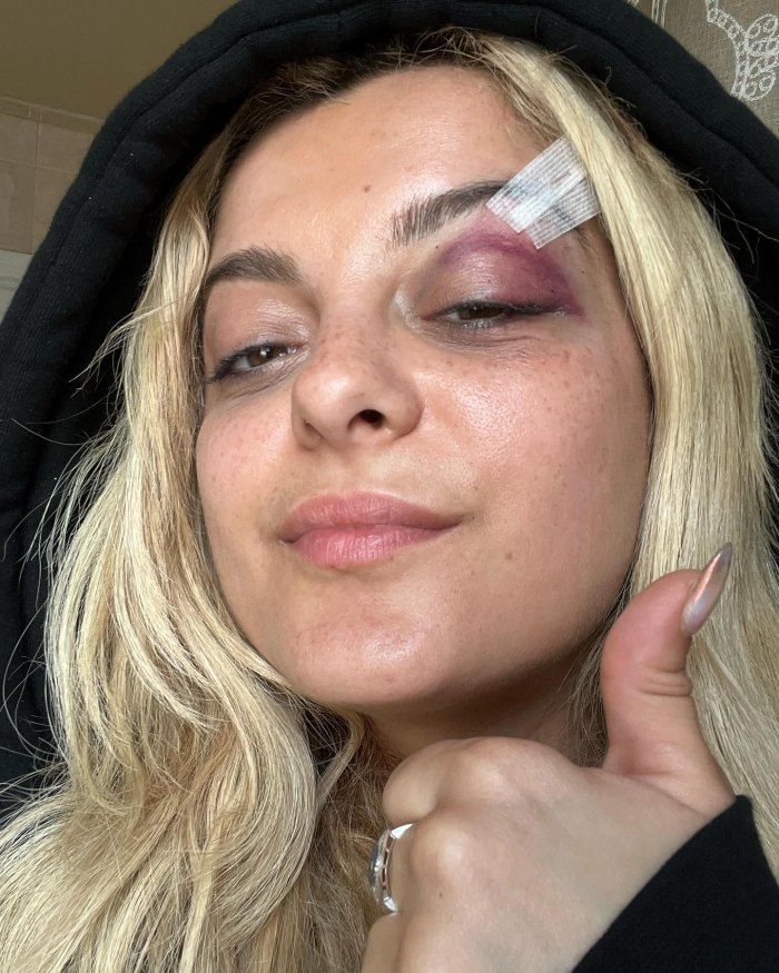 Bebe-Rexha-Shares-Black-Eye-Photos-After-Fan-Throws-Phone-at-Her-Face.jpg